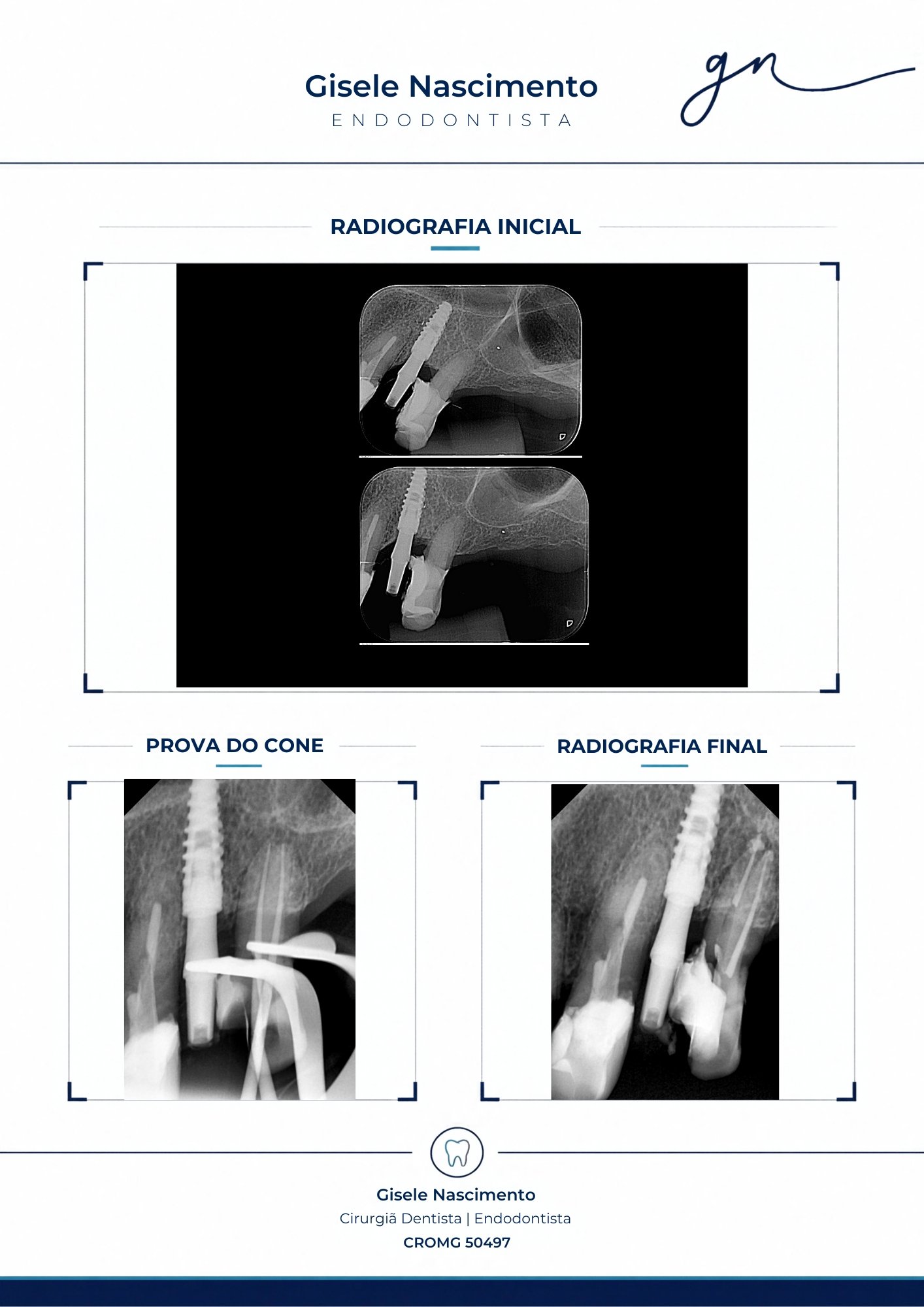 Relatório endodôntico - radiografias inicial, prova do cone e final
